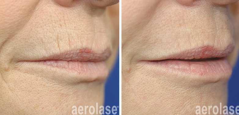 A before-and-after photo of a woman's lips.