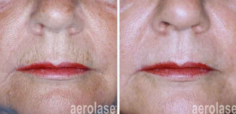 A before-and-after photo of a woman's face with red lips.