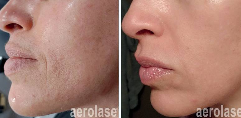 A before-and-after photo of a woman's face.