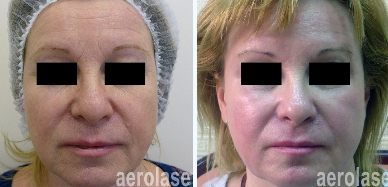 A before-and-after photo of a woman's face.
