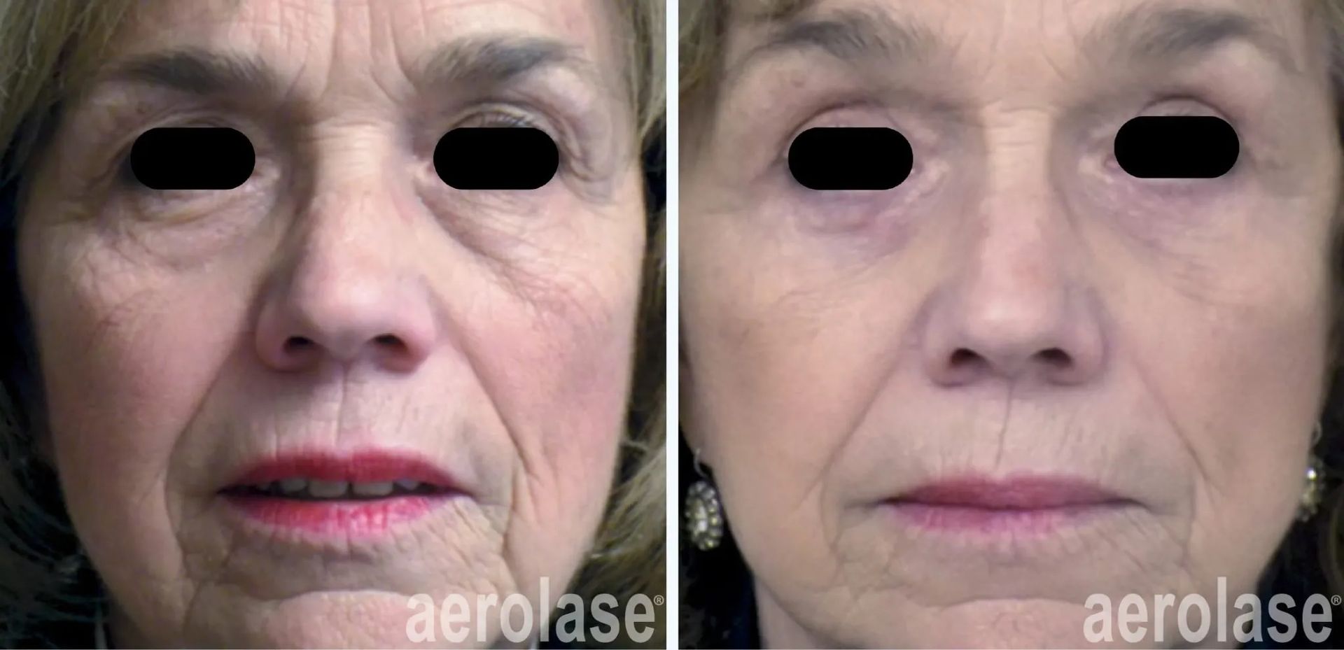 A before-and-after photo of a woman's face.
