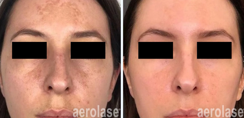 A before and after photo of a woman's face