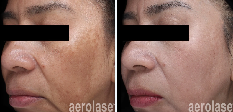 Two pictures of a woman's face before and after Aerolase treatment
