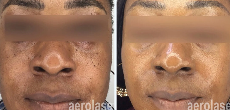 A before-and-after photo of a woman's face.