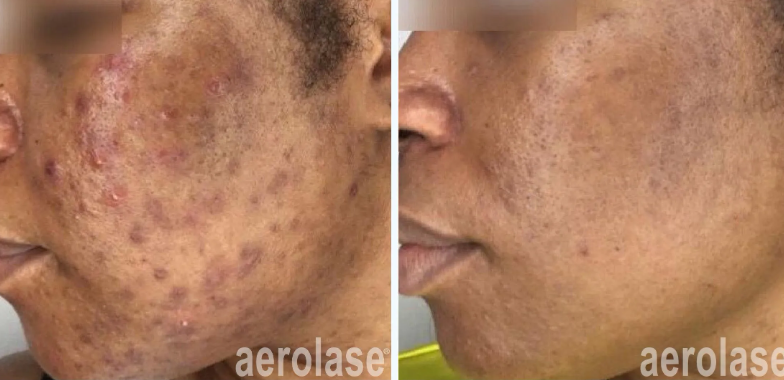 A before-and-after photo of a woman's face with acne.