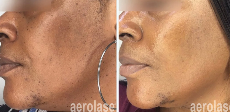 A before-and-after photo of a man and a woman's face.