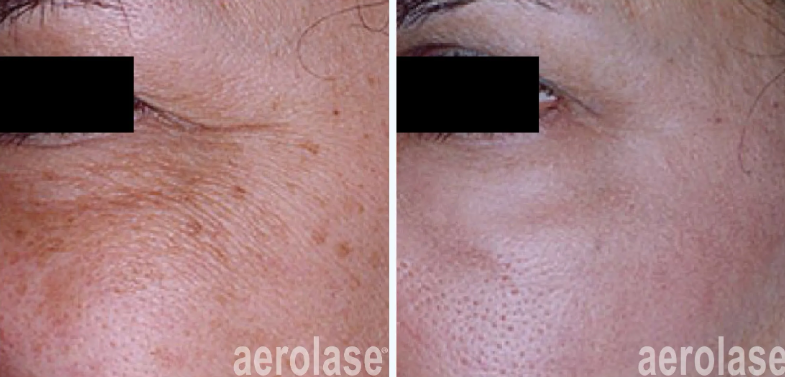 A before and after photo of a woman's face.