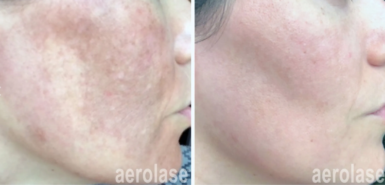 A before-and-after photo of a woman's face