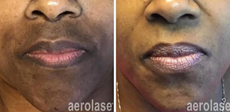 A before-and-after photo of a woman's face.