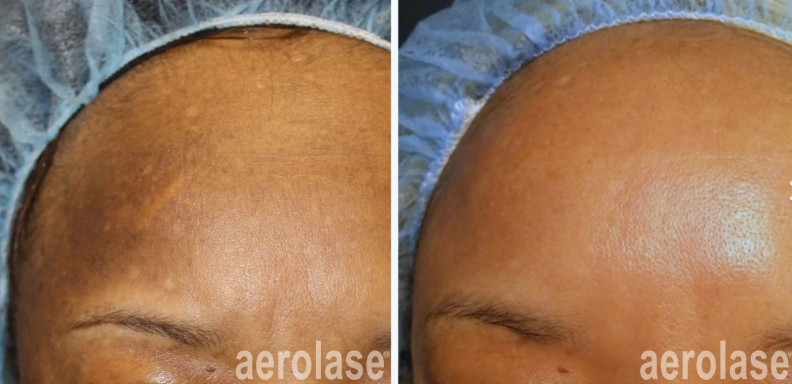 A before-and-after photo of a woman's forehead.