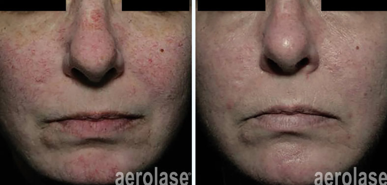 A before-and-after photo of a woman's face with red spots.