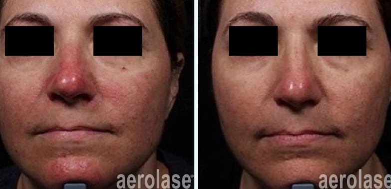 A before and after photo of a man's face with redness