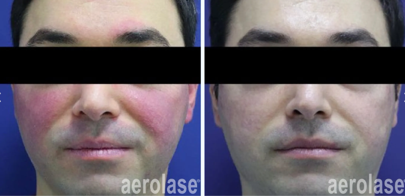 A before-and-after photo of a man's face with redness