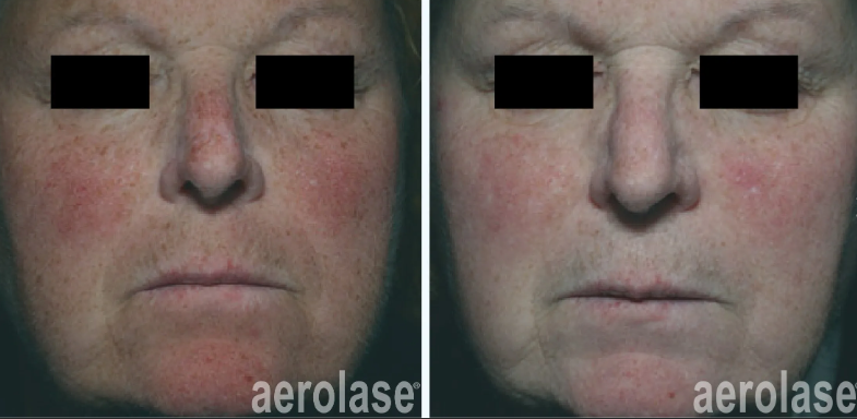 Two pictures of a woman's face before and after Aerolase treatment