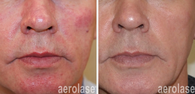 A before-and-after photo of a woman's face