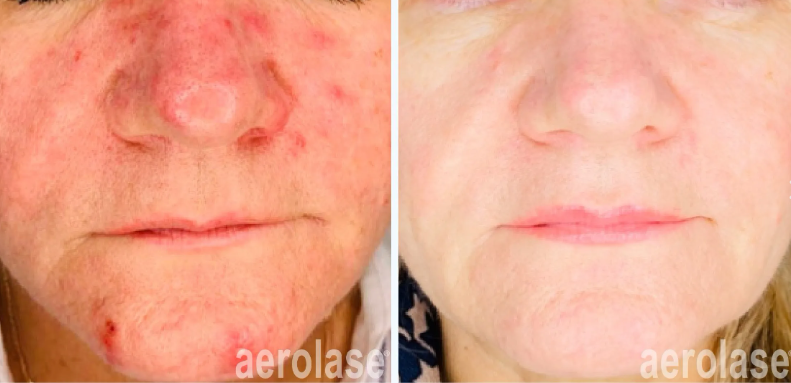 A before-and-after photo of a woman's face with red spots on it.