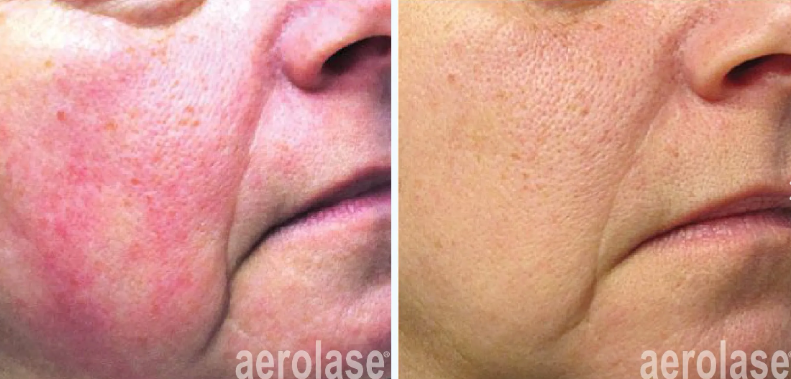 A before-and-after photo of a woman's face.