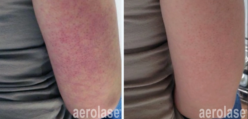 A before-and-after photo of a person's arm with aerolase written on it