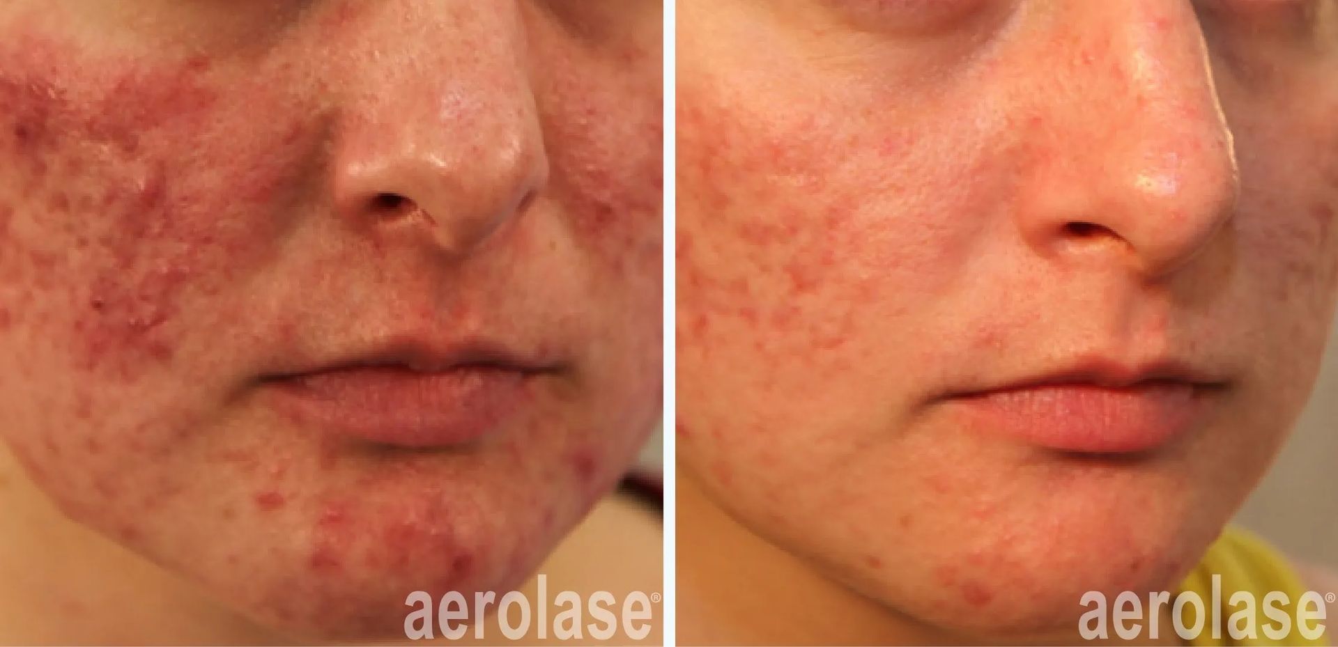 A before-and-after photo of a woman's face with acne.