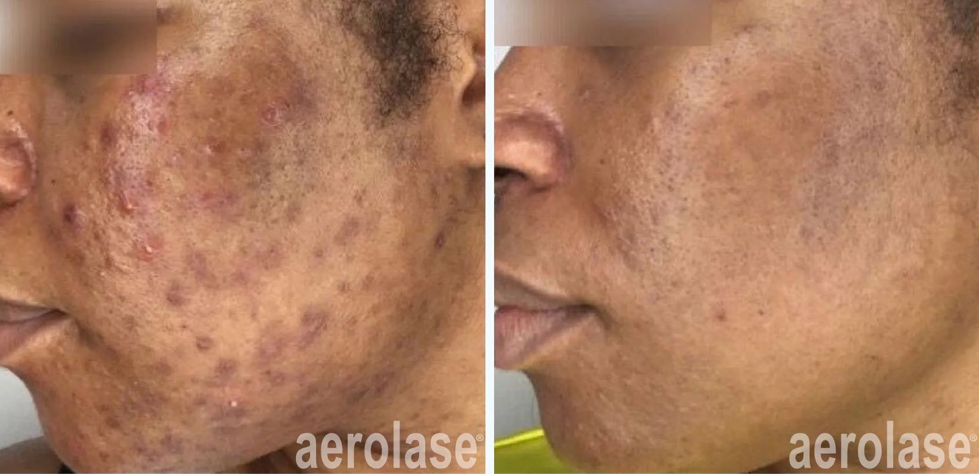 A before and after photo of a woman's face with acne.
