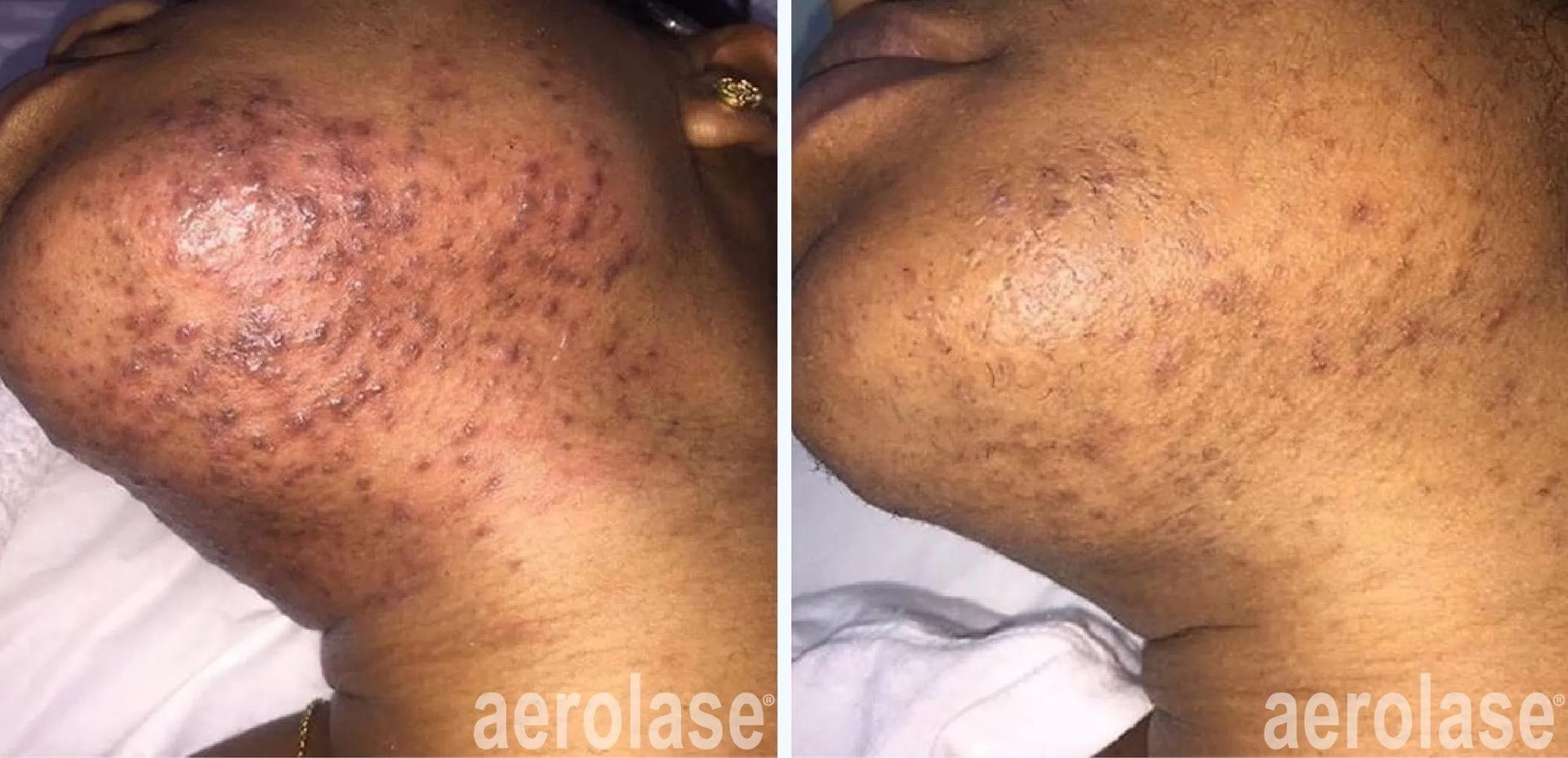 A before-and-after photo of a woman's face with acne.