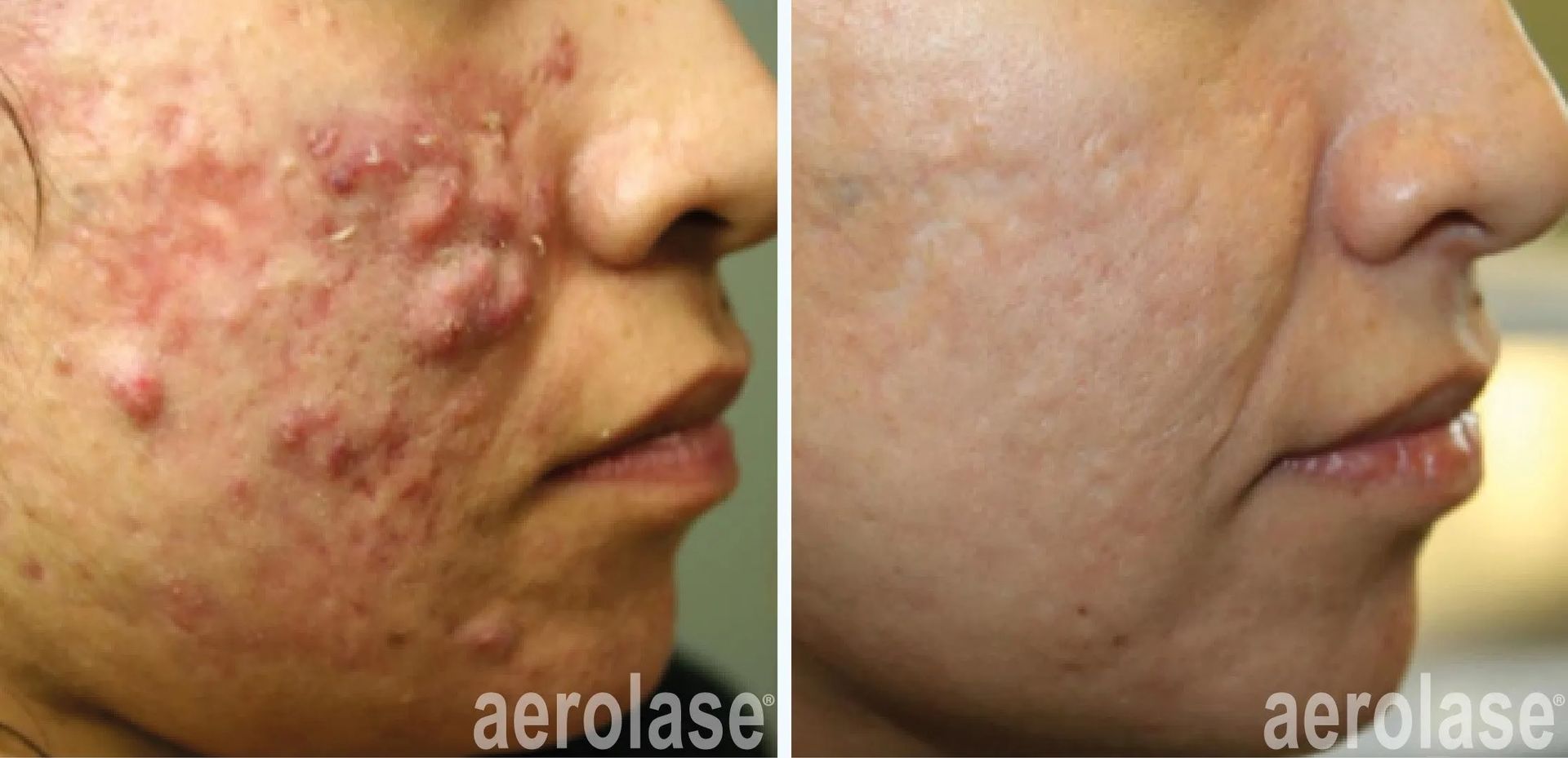 A before-and-after photo of a woman's face with acne.