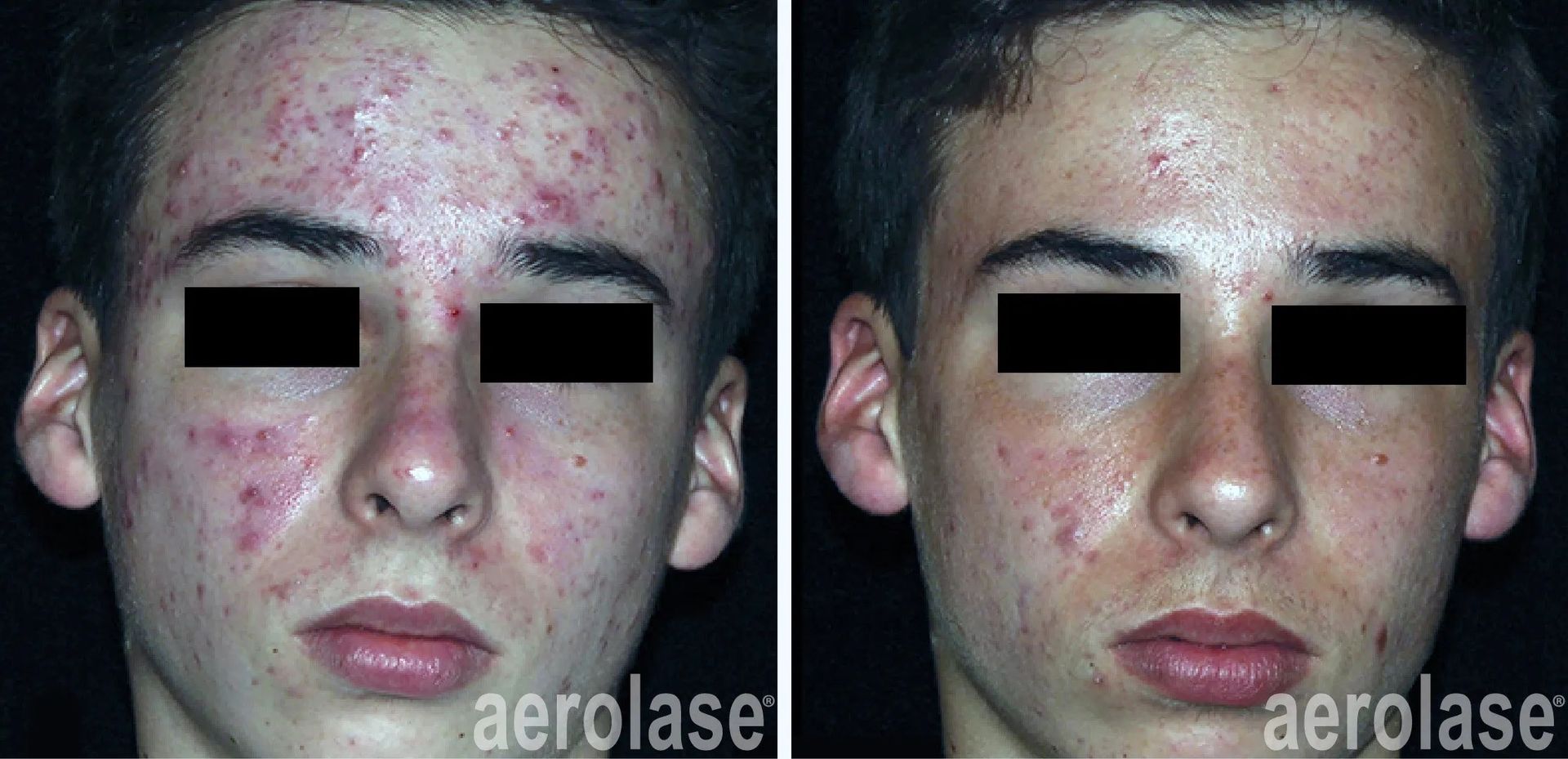 A before and after photo of a young man's face with acne.