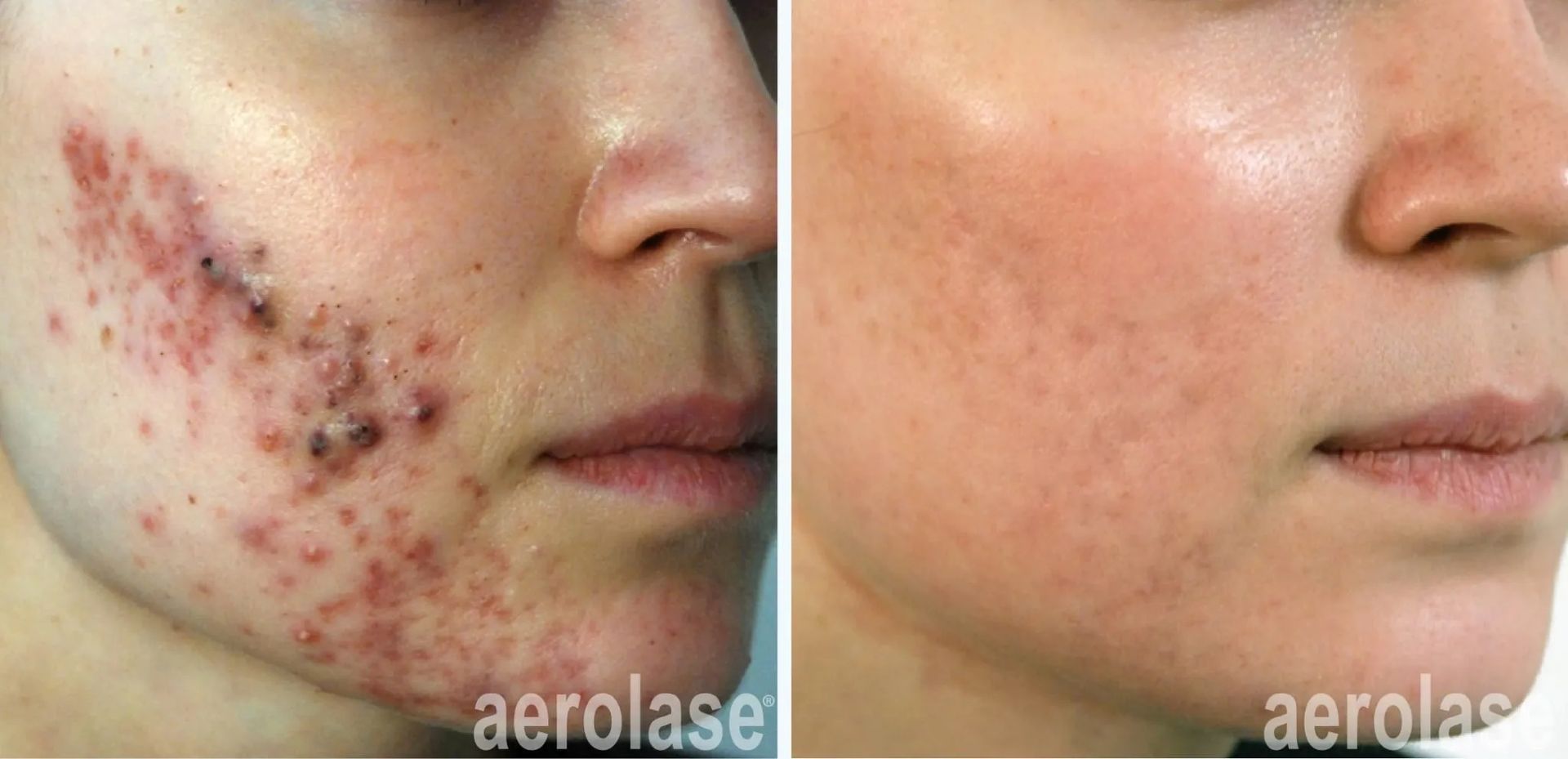 A before-and-after photo of a woman's face with acne.