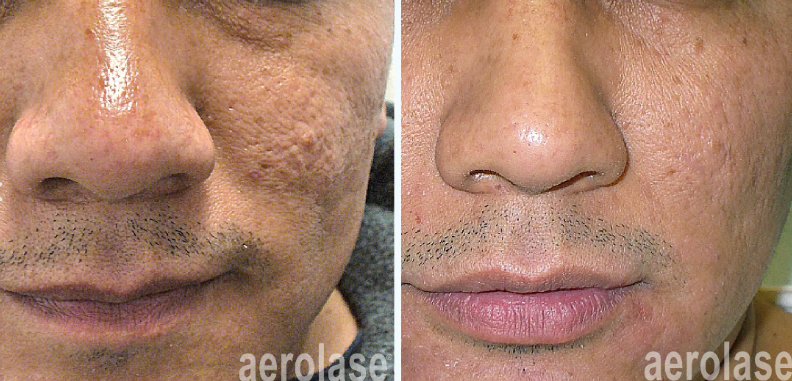 A before and after photo of a man's face.