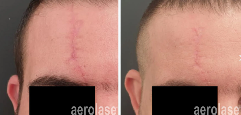 A before and after photo of a man's forehead