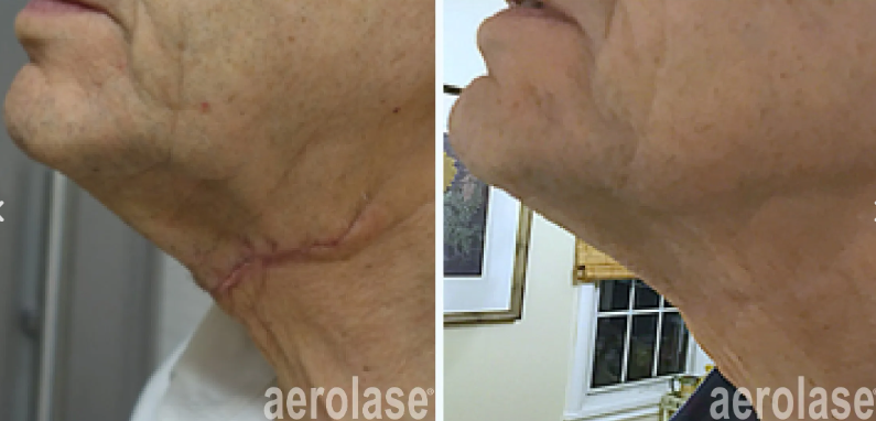 A before and after photo of a woman's neck and face.