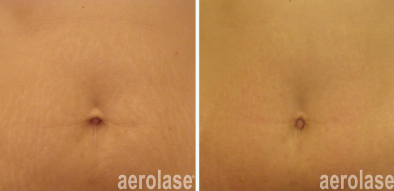 A before and after photo of a woman's belly with aerolase written on the bottom