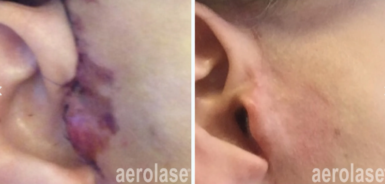 A before and after picture of a person's ear