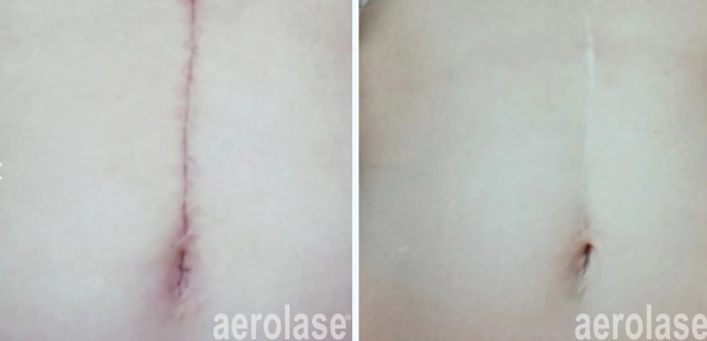A before-and-after photo of a woman's belly with aerolase written on the bottom