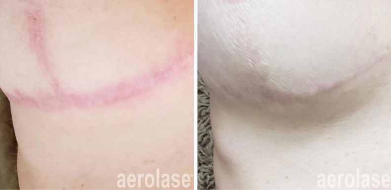 A before and after photo of a person's stomach with a scar.