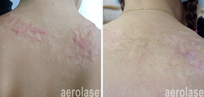 A before-and-after photo of a woman's back with acne scars.