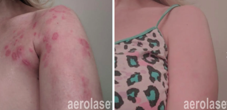 A before-and-after photo of a person's hands with psoriasis.