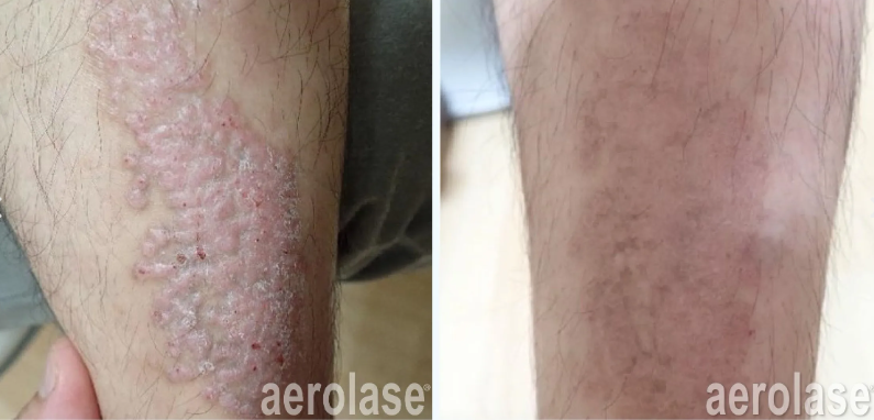 A before and after photo of a person's leg with psoriasis.