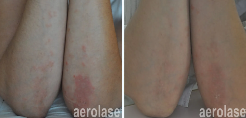 A before-and-after photo of a person's hands with rings on them.