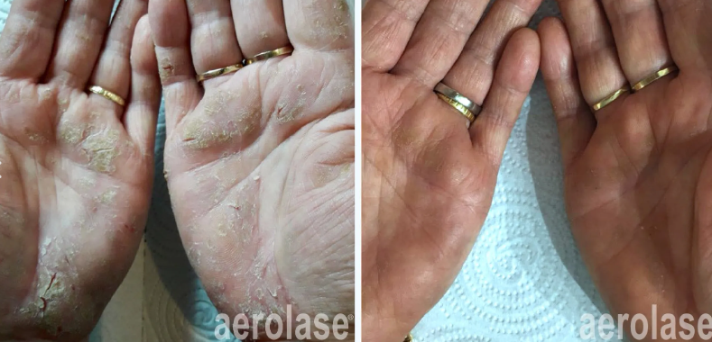 A before-and-after photo of a person's hands with rings on them.