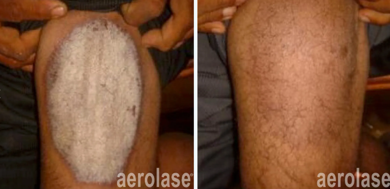 A before-and-after photo of a person's leg with the words aerolase on the bottom