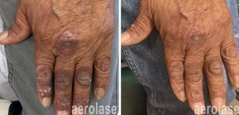 A before-and-after photo of a person's hands with psoriasis.