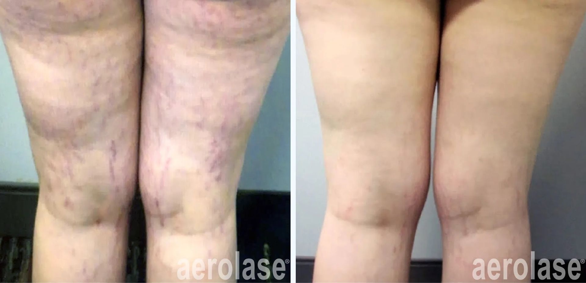 A before and after photo of a woman's legs with spider veins.