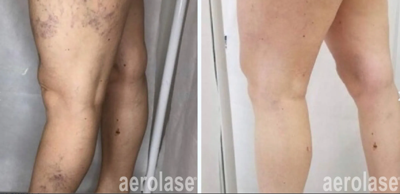 A before-and-after photo of spider veins on a person's legs.