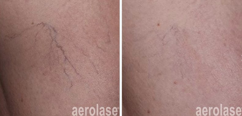 A before-and-after photo of spider veins on a person's legs.