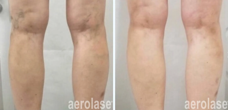 A before and after photo of a person's legs