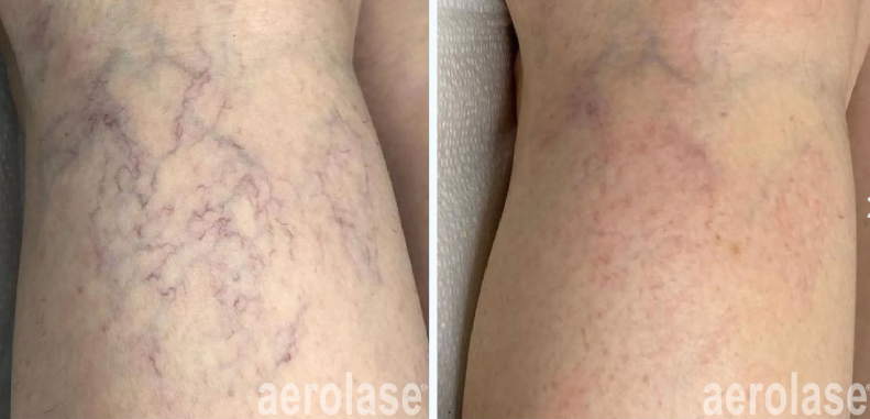A before-and-after photo of a person's leg with varicose veins.