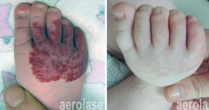 A before-and-after photo of vascular lesions