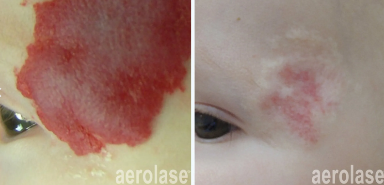 A before-and-after photo of vascular lesions removal