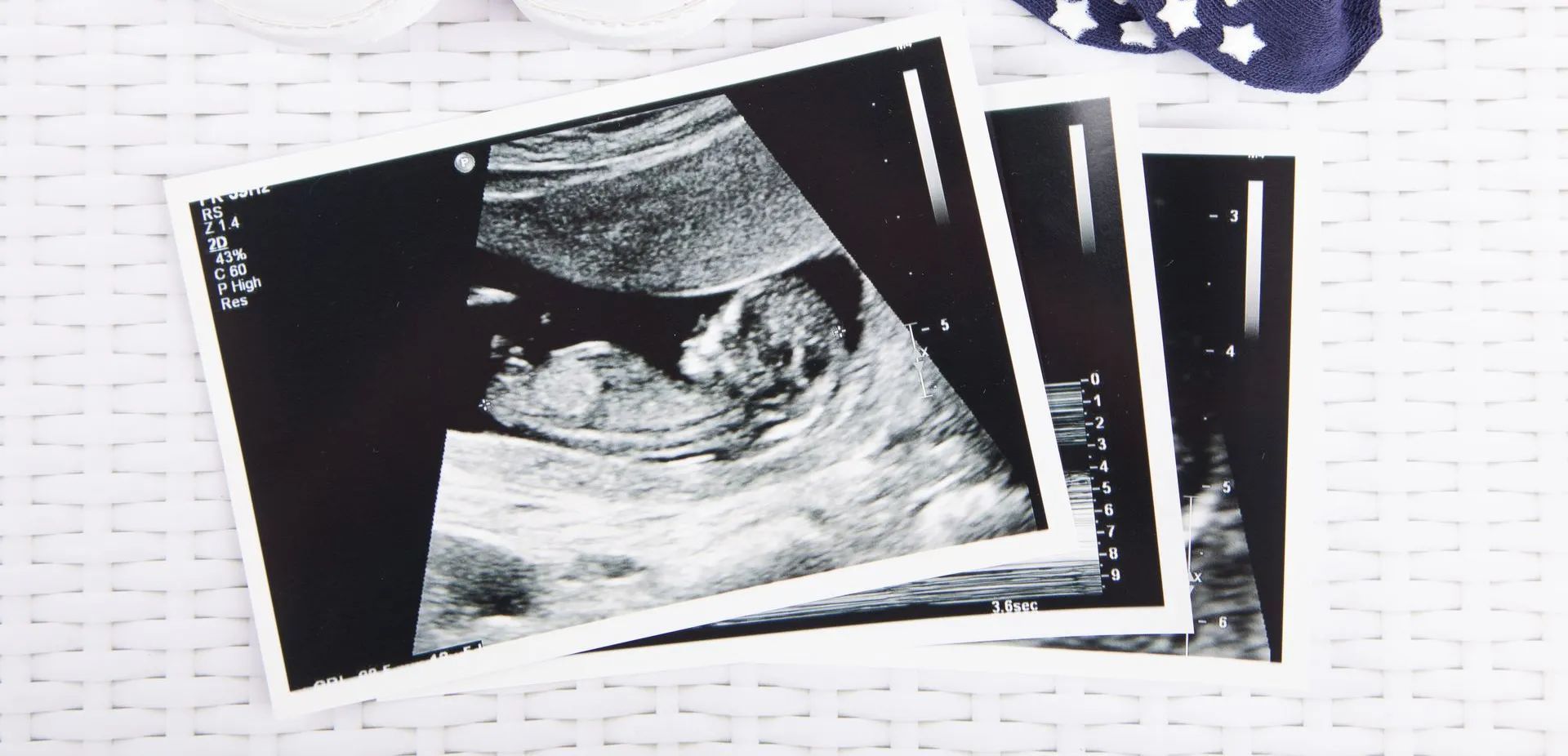 Ultrasound scans of a fetus next to baby items on a white quilted surface.